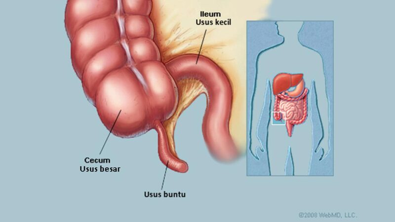 Cara Mengobati Usus Buntu Tanpa Operasi
